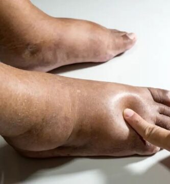 Remedios para la retención de líquidos Remedios para la retención de líquidos